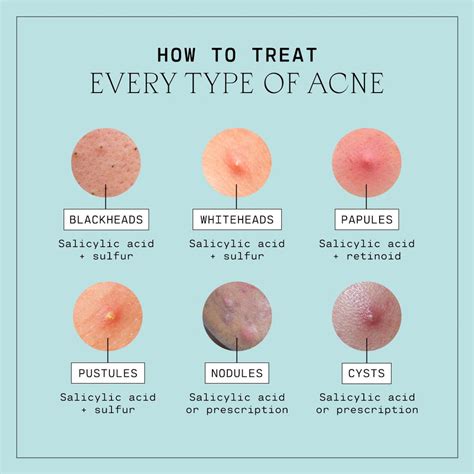 Types of Acne, Explained