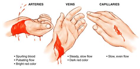 First Aid Heavy Bleeding 的图像结果