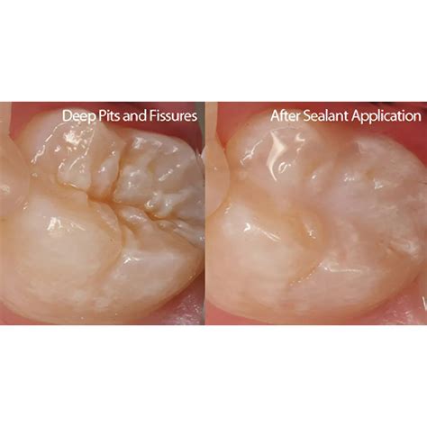 Buy Prime Dental Restorite Pit & Fissure Sealant – Oralkart