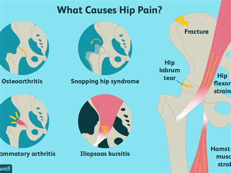 Hip Problem Pain 的图像结果