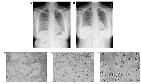 Lump On Chest Near Sternum