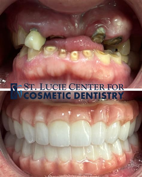 Where to Get Full Mouth Dental Implants in Florida? - St Lucie Center for Cosmetic Dentistry ...