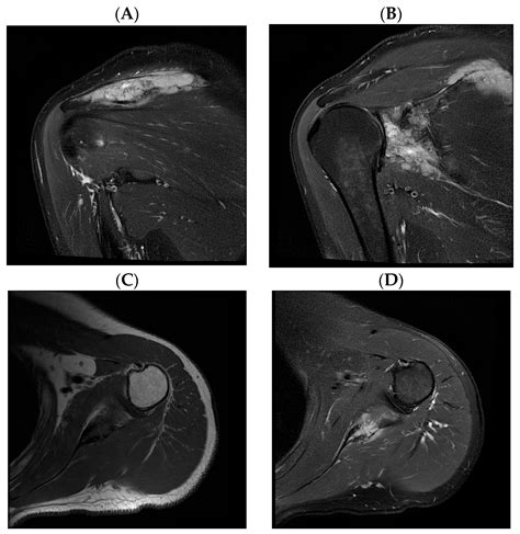 Primary Bone Lymphoma of the Scapula