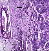Image result for 钙化 calcifications