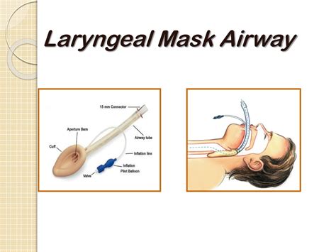 Procedure Code For Laryngeal Mask Airway at Bobbye Shelley blog