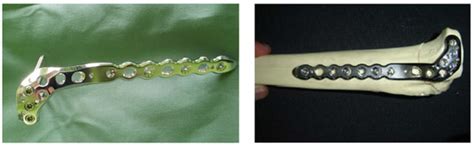 Investigation of Biomechanical Characteristics of Orthopedic Implants ...