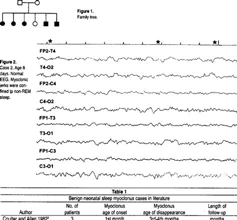 Table 1 from Benign Neonatal Sleep Myoclonus: Case Report and Follow-up ...