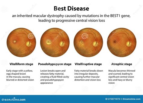 Treatment For Best Disease