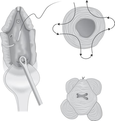 Evidence-based Approach for Preventing Preterm Birth: Cervical Stitch ...