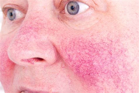 Link between rosacea and systemic inflammatory diseases