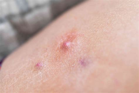 Boil on Inner Thigh: Symptoms and Treatment Options