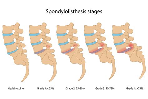 Spondylitis Beispiele | (Spondylitis ankylosans) – JVTP