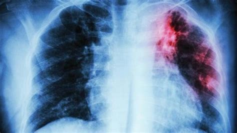 India’s DR-TB problem: When silence, delays, and half-measures cost lives