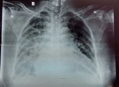 Chest X Ray Findings Pulmonary Edema at Sarah Bugarin blog