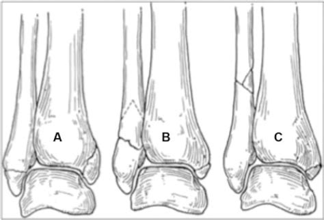 SciELO Brasil - Evaluation of the Reproducibility of Lauge-Hansen ...