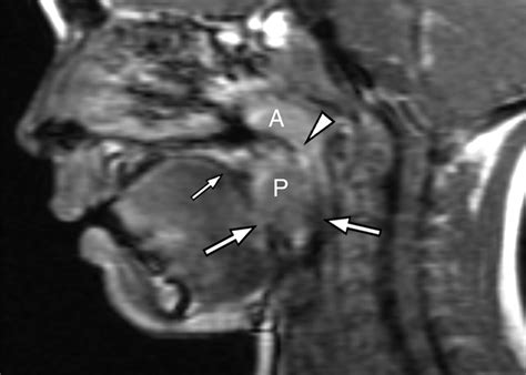 Enlarged Adenoids And Palatine Tonsil Image Tonsillitis And When Is