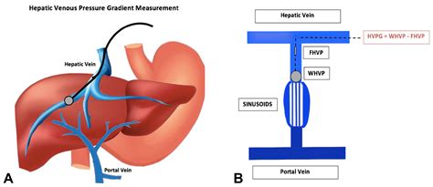 Measurement Of Portal Hypertension