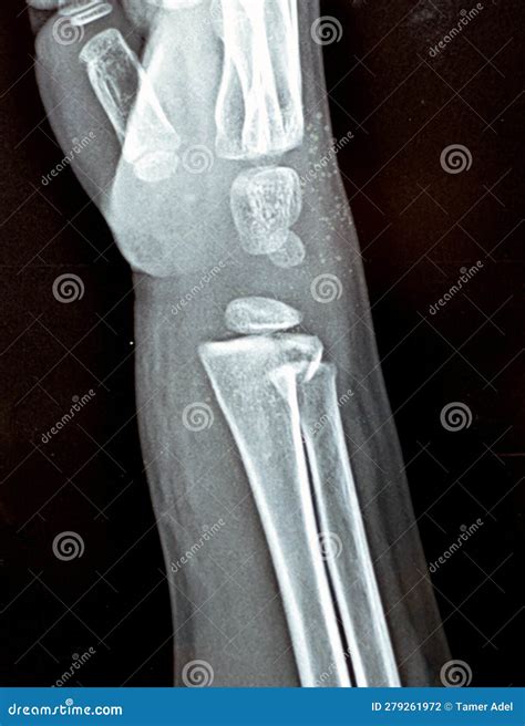 Plain X Ray Right Wrist Joint Shows Right Distal Radius Fracture ...