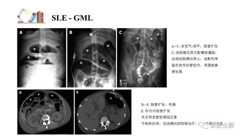 【PPT】 系统性红斑狼疮（SLE）的腹部影像表现 – 影像PPT