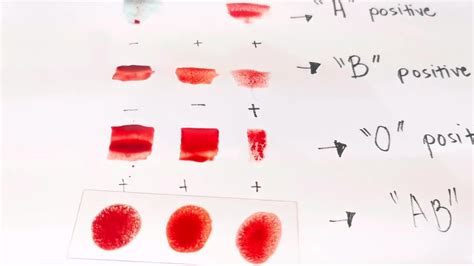 Blood Typing Procedure (Agglutination Test) | Blood Typing Procedure (Agglutination Test) by ...