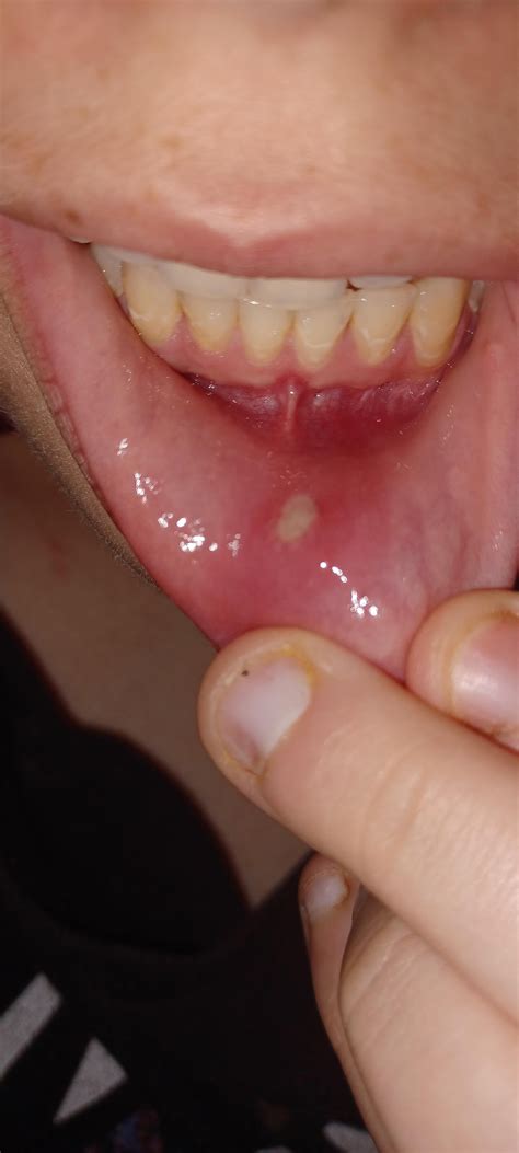 Help me! I can't tell if my canker sore is in the stage of healing or ...