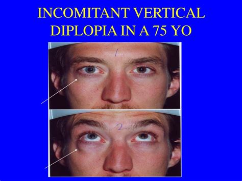 Image result for Intractable Diplopia