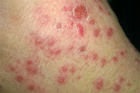 Image result for Rash Algorithm Pityriasis
