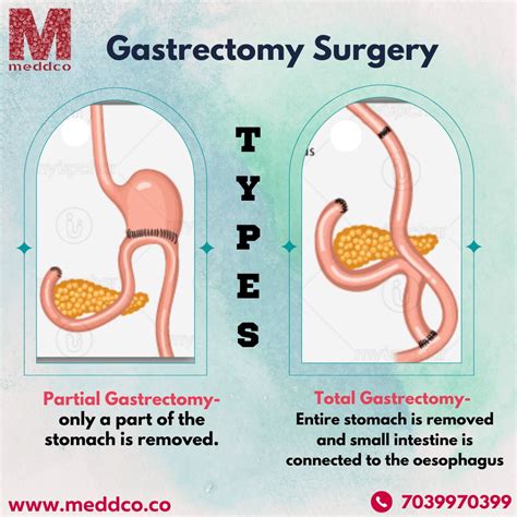 Subtotal Gastrectomy Surgery