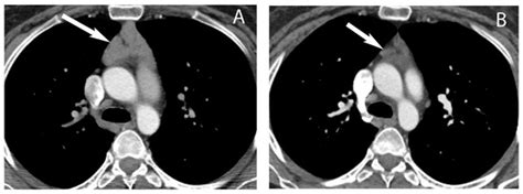 Diagnostics | Special Issue : Selected Topics in Thoracic Pathology