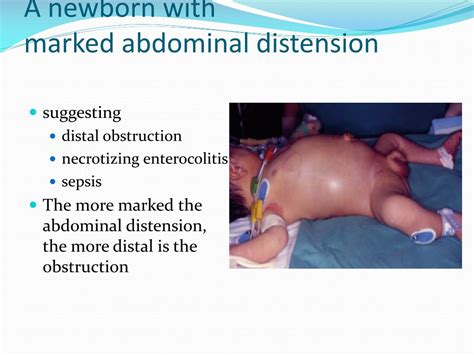 PPT - Neonatal intestinal obstruction PowerPoint Presentation, free ...