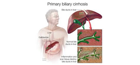 Primary Biliary Cirrhosis Treatment | Dr. Kiran Peddi