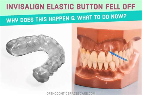 Invisalign Buttons 的图像结果