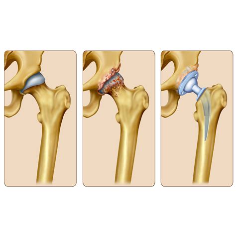 Hip Replacement (Total/Partial) - Dr. Savla