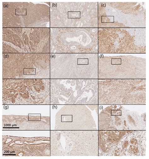 AKR1B1 and AKR1B10 as Prognostic Biomarkers of Endometrioid Endometrial ...