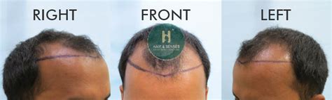Hair Transplant Case Study with 2500 Grafts in 24 Years Aged Person ...