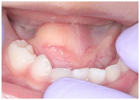 Image result for Abscess Explosion