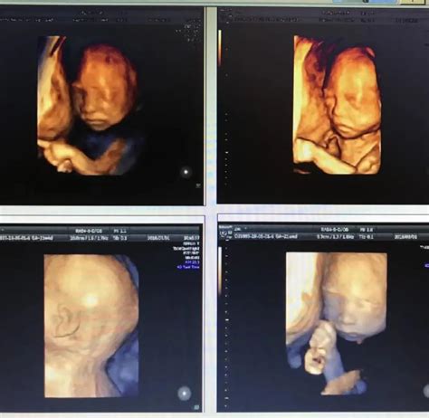 怀孕28周3天照了四维彩超大家给看看是男孩还是女孩 - 百度宝宝知道