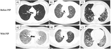 Medical Pna Abbreviation