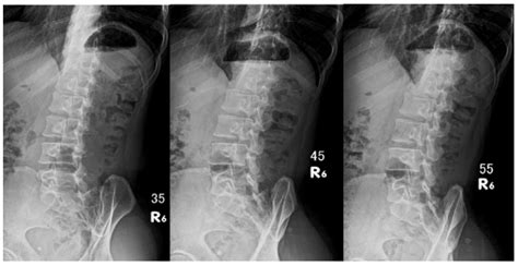 Evaluation of Optimized Lumbar Oblique X-Ray Angles with Positioning Assistance for Enhanced ...