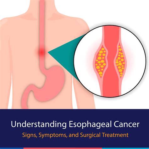 Oesophagus Cancer Symptoms And Signs