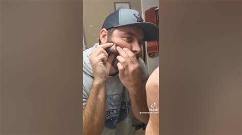 Image result for Large Pimples Exploding