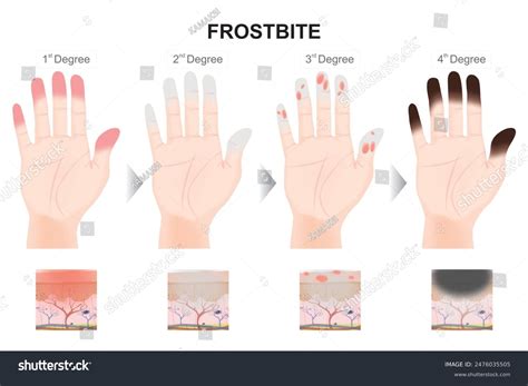 Frostbite 4-degree Stages Hand Illustration Stock Illustration 2476035505 | Shutterstock