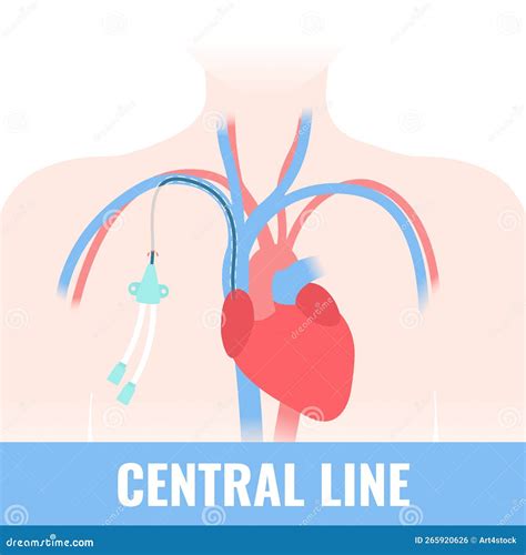 Tunneled Central Line Venous Catheter Medical Diagram Stock Vector - Illustration of cardiac ...