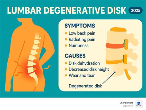 Lumbar Degenerative Disk: Conquer 4 Stages