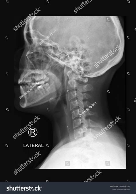 Healthy Cervical Spine Xray