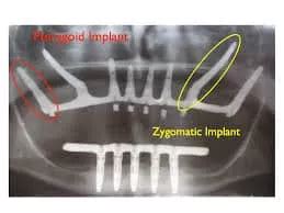 Dental Implant Cost in Powai, Mumbai | Dr. Karve's Dentech