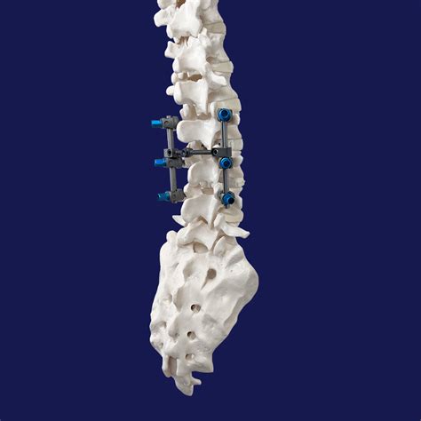 Image result for Spinal Fixation