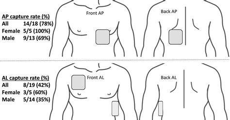 Anteroposterior Pacer Pad Position Is More Likely to Capture Than Anterolateral for ...