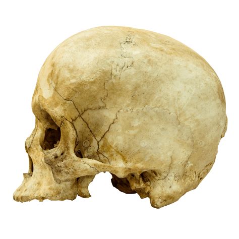 Isolated View Of A Fractured Human Skull Side View From An Asian Or ...