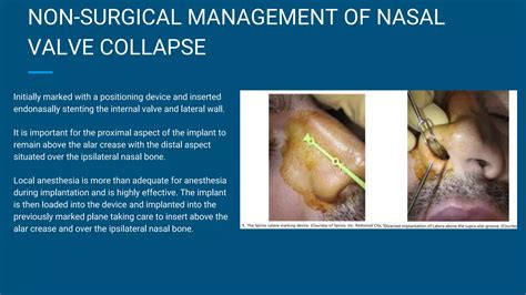 Surgical Management of Nasal Valve Insufficiency .pptx